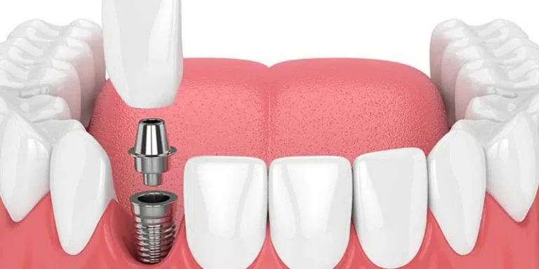 Revitalize Your Smile with Implants At City Clinic Cork