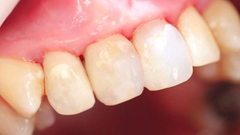After dental treatment – case 2
