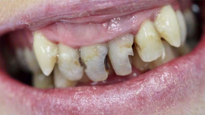 Before dental treatment – case 2