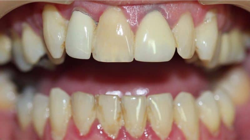 Before dental treatment – case 1