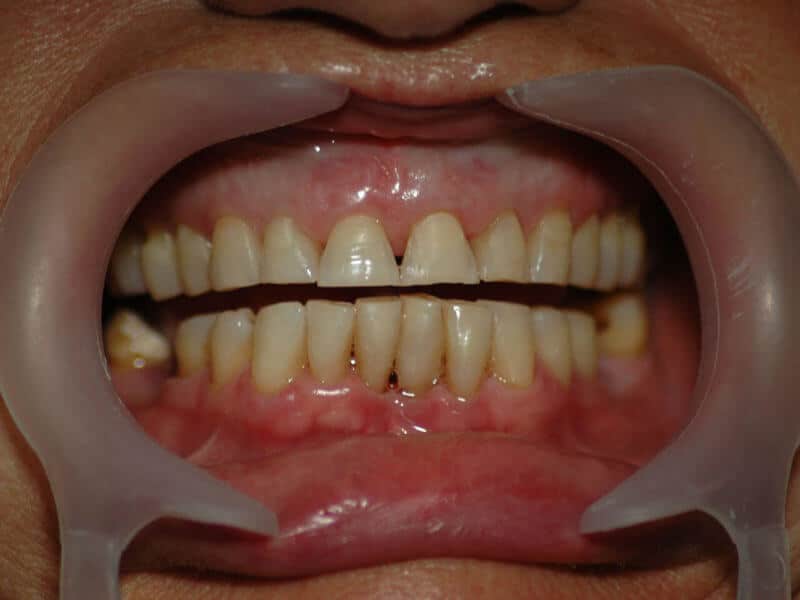 Before dental treatment – case 6