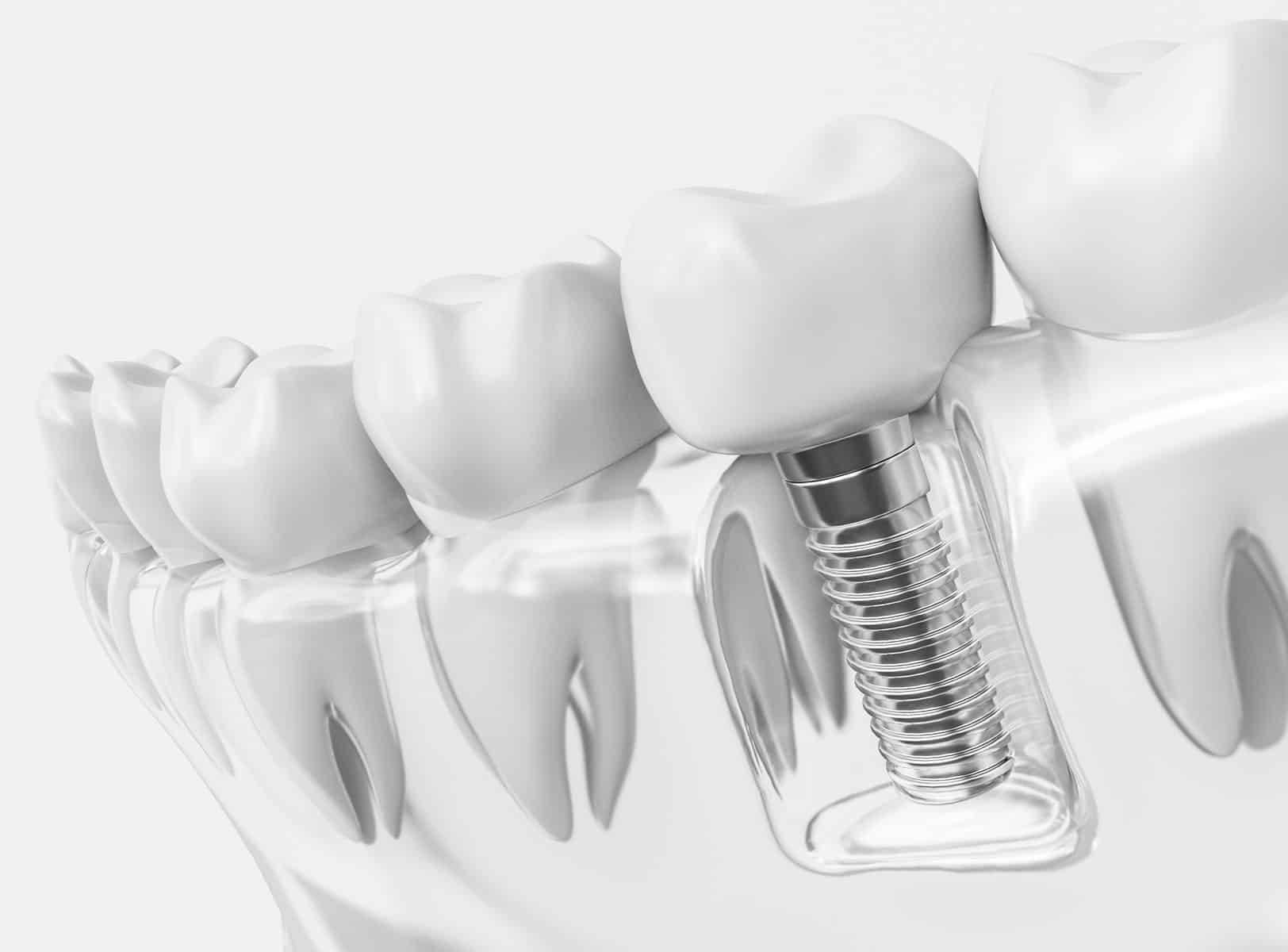 City Clinic – implant1